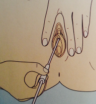 menstruáció alatt vizelési inger Faringit prosztatitis